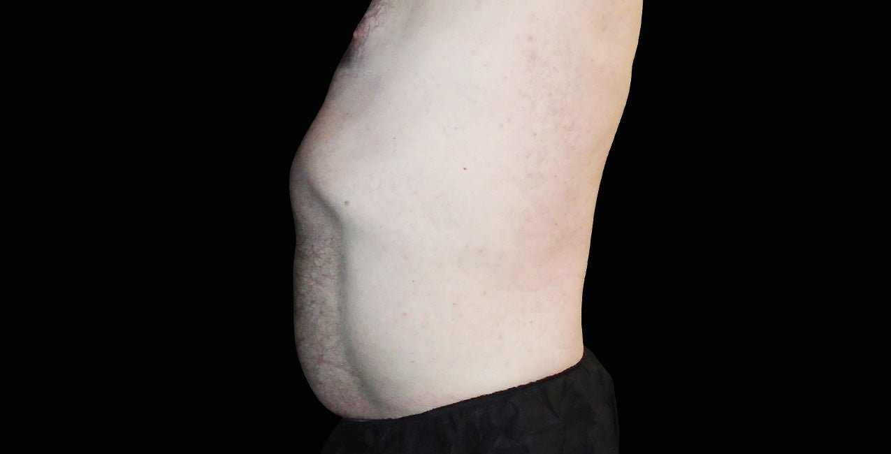Emsculpt_Neo-Emsella_PIC_Ba-card-male-abdomen-021_ENUS100_after_f3e19b07-3326-4fc5-a96e-c69df9c87fdc