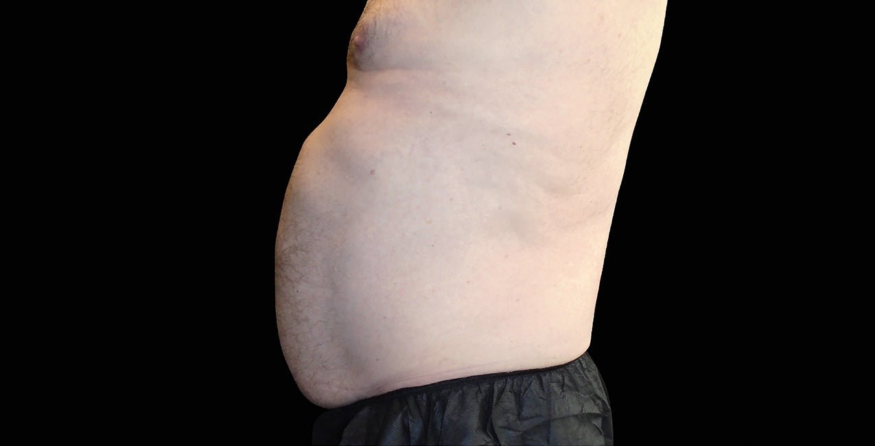 Emsculpt_Neo-Emsella_PIC_Ba-card-male-abdomen-021_ENUS100_before_823584a4-a71e-4e92-890a-68f3e5165d88 Emsculpt_Neo-Emsella_PIC_Ba-card-male-abdomen-021_ENUS100_before_823584a4-a71e-4e92-890a-68f3e5165d88